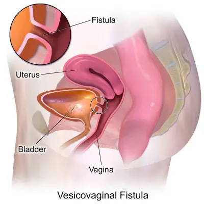 Photo of VVF